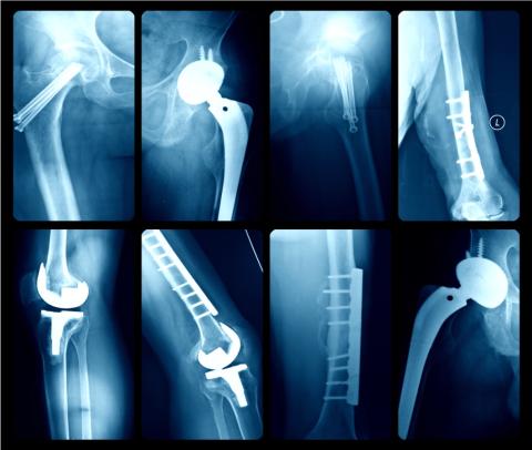 X-rays of medical implants